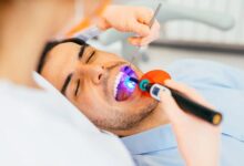 Dental sealants
