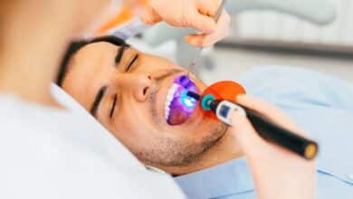 Dental sealants